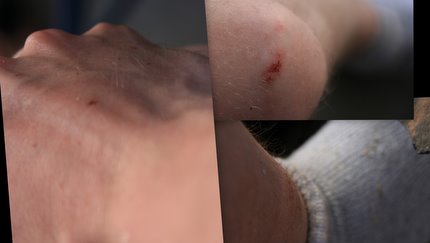 Meine Verletztung nach dem Abflug von einem der unzähligen Steine